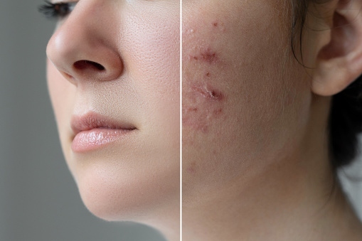 When Acne Strikes: Strike Back With These Tips!